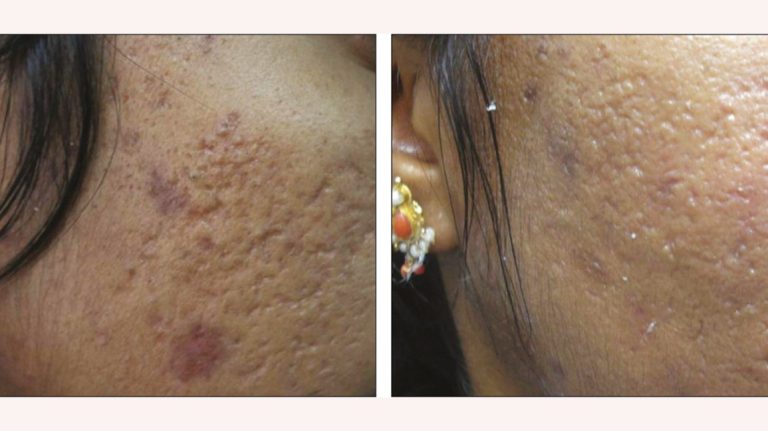 Plastic Surgery For Acne Scars