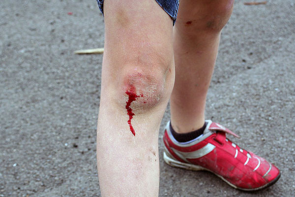 Wounds