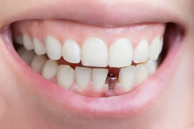 Dental Implants