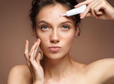 The Connection Between Dandruff and Acne