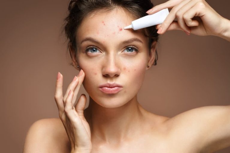 Dandruff and Acne