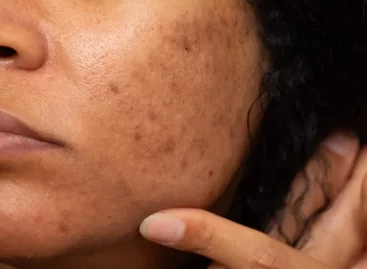 Acne and Dark Spots