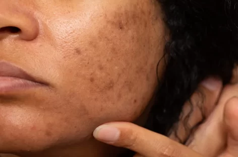 Acne and Dark Spots