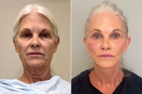 A Journey Through Time: How Plastic Surgery Has Evolved Over the Decades